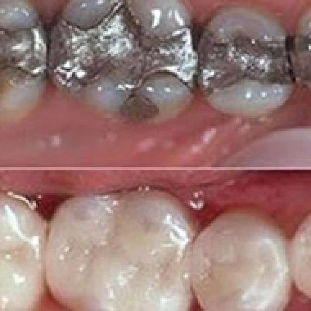 CEREC® Dentistry
