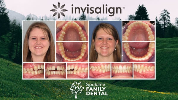 Before and After - Invisalign