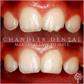Cosmetic Dental Bonding Spokane - Before and After