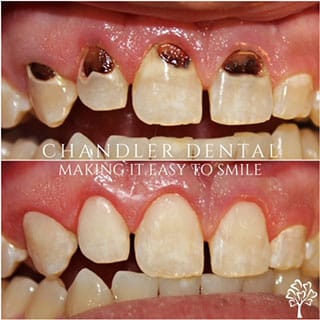 Cosmetic Dental Bonding Spokane - Before and After