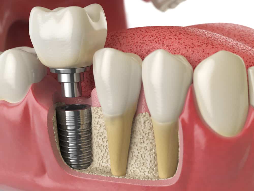 Implant Crown Example