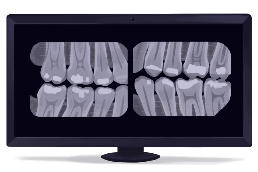 Dental X-Rays -Intraoral - Spokane Family Dental